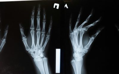 Is Arthritis Hereditary?
